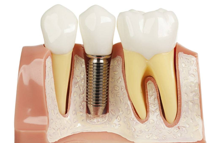 Профессиональный стоматолог всегда сможет подобрать максимально эффективный метод лечения для вас.